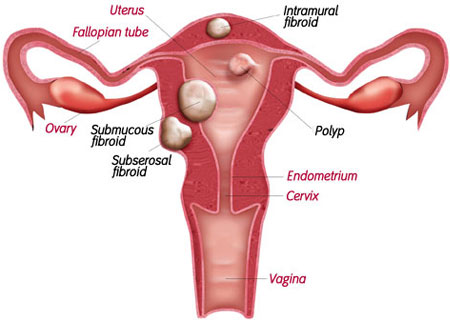fibroidi, bol u zdjelici, simptomi, menstrualna krvarenja, Dugotrajne menstruacije, Učestalo mokrenje, Bol u leđima, ultrazvučno uklanjanje fibroida, miomi maternice, gljivične infekcije, dijabetes, dobre bakterije, Probiotički tretman, ginekologija
