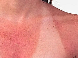 ljetovanje, opekline, plaža, jadransko more, bol od opeklina, opekline, sunčane opekline, sunčane opekline, prva pomoć, kuhinja