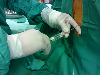 silikoni, panika, Francuska