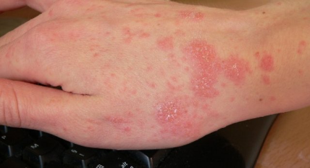 šuga, Mostar, bolest, šuga, Mostar, Mostar, kuga, šuga, kolera, šuga, kožne bolesti, šuga, Zavod za javno zdravstvo HNŽ-a