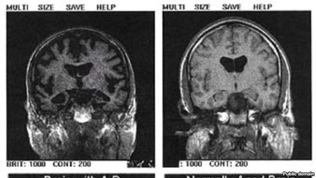 Alzheimerova bolest, Alzheimer Disease International, znanstveni rad 