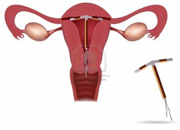 unutarmaternična sredstva, vrste kontracepcije, Razina učinkovitosti, rok trajanja, sprečavaju prolazak sperme, plastični ili bakreni uređaji, kontracepcija, Umeću se kirurškim putem