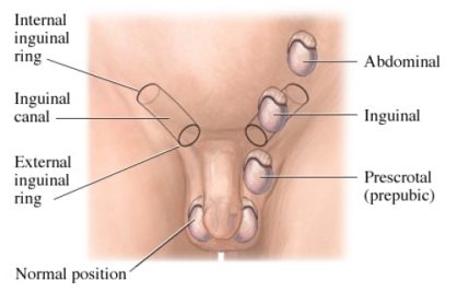 testisi, testisi, Nespušteni testisi, pubertet, pubertetske tegobe, penis