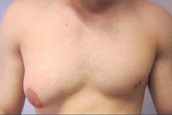 dojka, farshad hashemzsdeh, narasla dojka