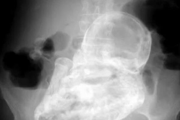 fetus, 40 godina, u stomaku