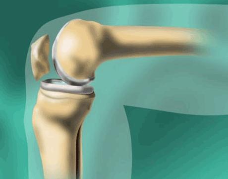 koljeno, bol, istezanje, Fizikalna terapija, Protuupalni lijekovi, Kortizon