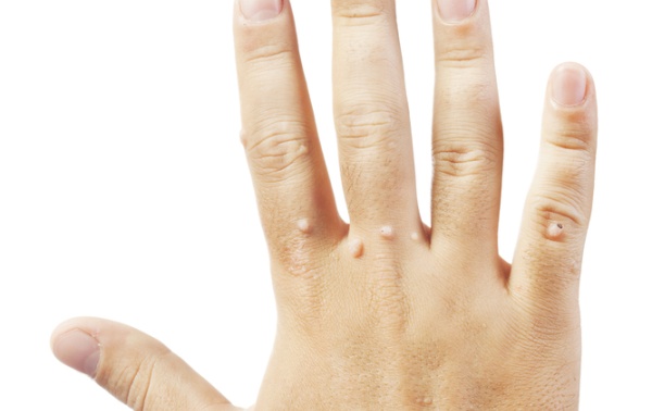 virusne bradavice, u obliku nepravilnih kvržica, krioterapija, lasersko odstranjivanje, disekciju, rosopas