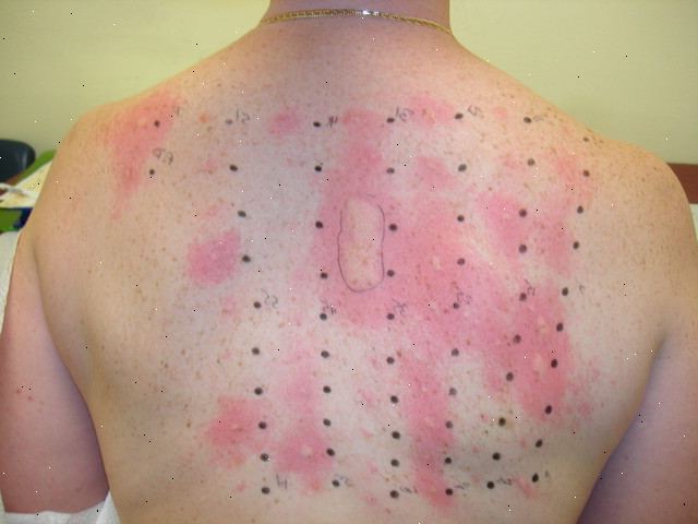 kikiriki, alergija, imunosni sustav, kikiriki u hrani, liječenje