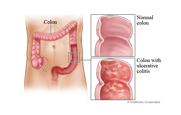 katar, prirodno liječenje, debelo crijevo, kolitis, Sastav čaja