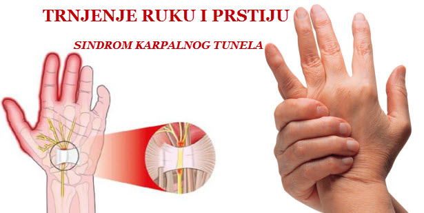 karpalni ligament, karpalni kanal, Medijanus, Sindom karpalnog kanala, Utrnutost, trnci, osjećaj žarenja, simptomi, bolovi u podlaktici