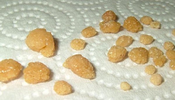 bubrezi, Bubrežni kamenci, mokraćovod, bolovi, krv u mokraći