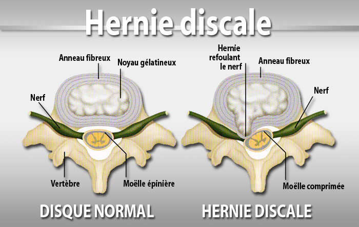 Hernija, Hernija diska, Utrnulost ili trnci, slabost, Uzroci hernije, Fizioterapeuti, Operacija hernije, disk, bolest lumbalnog diska, Hernija, Prolaps diskusa, Križobolja