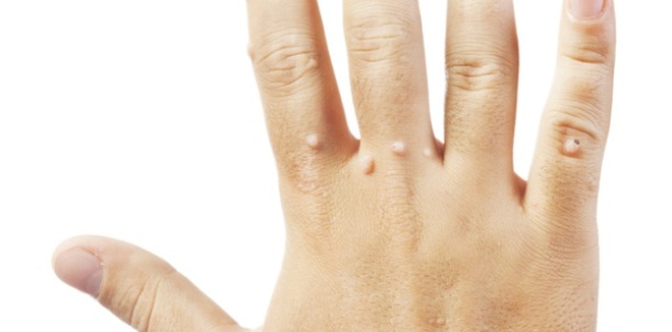 Uklanjanje madeža, otklanja bradavice, ambulantno, kirurškim putem, u lokalnoj anesteziji, virusne bradavice, bradavice, liječenje bradavica, otklanja bradavice, bradavice, otklanja bradavice, virusne bradavice