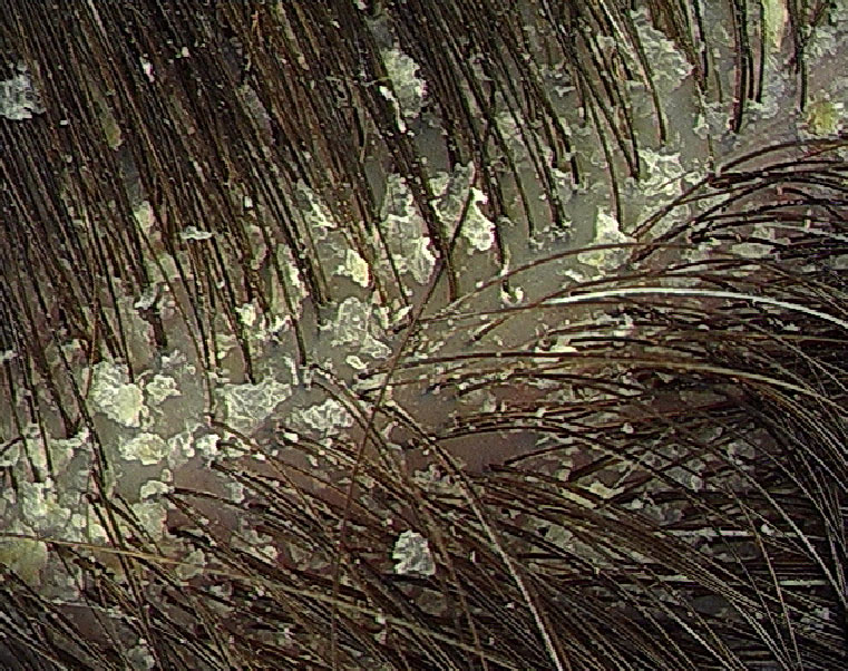 prhut, maslinovo ulje, aloa vera, depresija, Neadekvatna higijena, dijabetes, Genetsko nasljeđe, alergije, stres