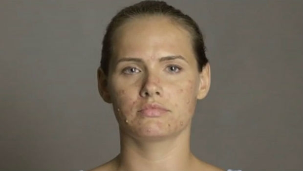 akne, manekenka, šminka