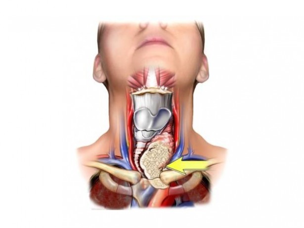 Štitnjača, štitna žlijezda, tiroksin i tironin, genetika, znak hipotireoze, štitna žlijezda, zdravlje, loše za zdravlje, štitna žlijezda, Migrenske glavobolje, Hormonska neravnoteža, Neurološki simptomi, Vrtoglavica, Štitnjača, guša ili uvećanje štitnjače,  Struma, Čvorovi u štitnjači, Štitnjača, Guggul , ginseng , Ashwagandha