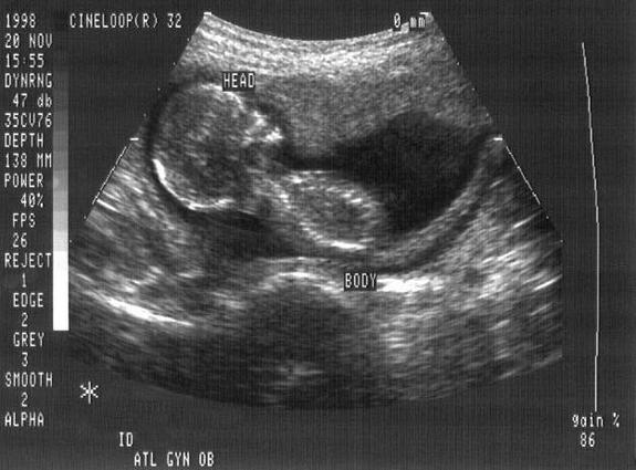 fetus, razvoj fetusa , trudnoća, u trudnoći,  nastanak života