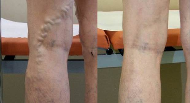 proširene vene, liječi proširene vene , ljekovita biljka