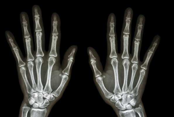 upala zglobova, bolovi u zglobovima, kod bolesnih zglobova, kosti, upala kostiju, Osteomijelitis, Liječenje osteomijelitisa, antibiotici