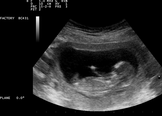 ultrazvuk, roditelji, roditelji i djeca, djeca roditelji