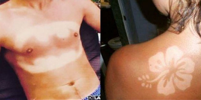 sunčane opekline, opekline