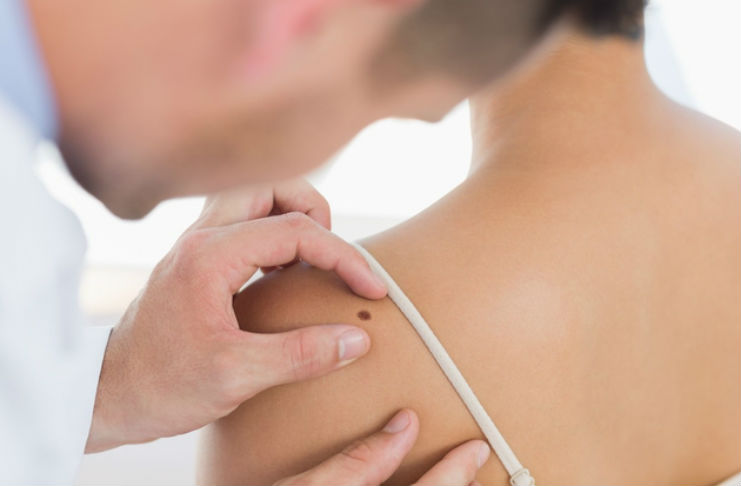 mladeži na tijelu, rak kože, istraživanje