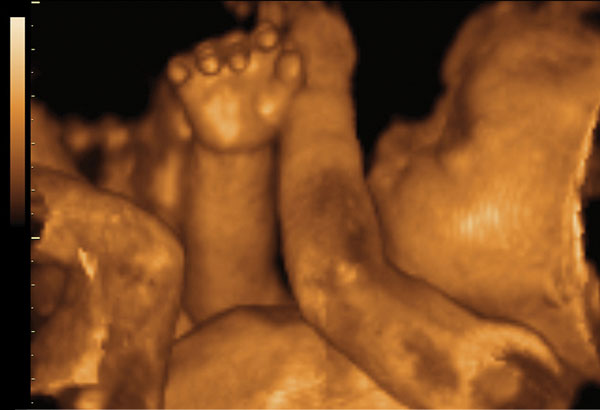 ultrazvuk 4D, ultrazvuk, beba, trudnoća