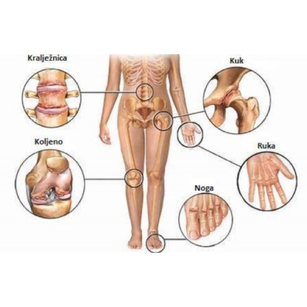 Bolesti zglobova, artroze , Hrskavica , deformacije zgloba