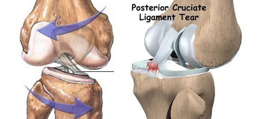 ligament, prednjeg križnog ligamenta, rehabilitacija, koljeno, problem s meniskusom
