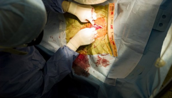 srce, transplatacija