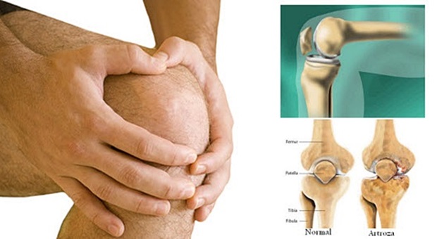 Artroza koljena, artroze , problem s meniskusom, tetive, koljeno, bol u koljenima, vježbe, pravilne vježbe