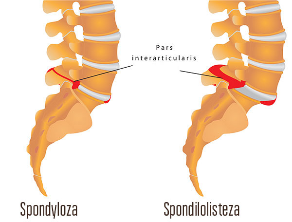 Spondilolisteza, Spinalna fuzija, neurološki problemi, Fizikalna terapija