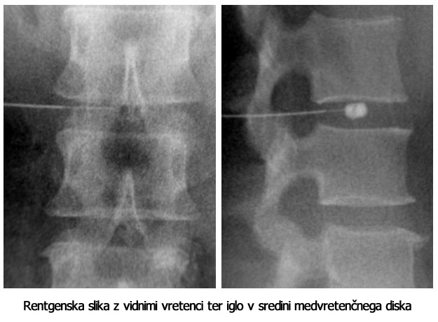 Ozon terapija, terapija kralježnice, ozljeda vratne kralježnice