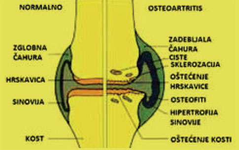 koljeno, osteoartritisa koljena, Artroza koljena