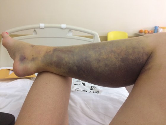 marina maslek, poskok, ugriz, ugriz zmije