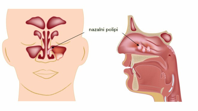Polipi u nosu, Bolesti dišnog sustava, simptomi