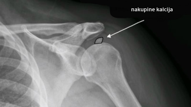 ramena, kalcifikat u ramenu