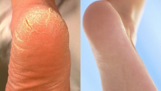 peta, pucanje kože, razlozi