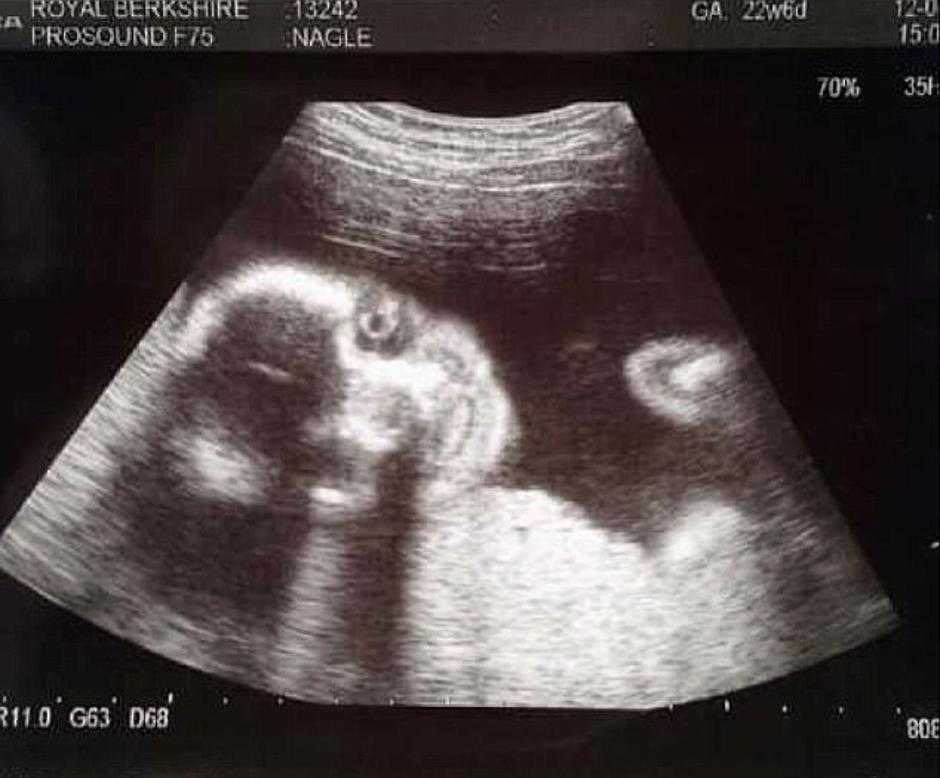 ultrazvuk, beba