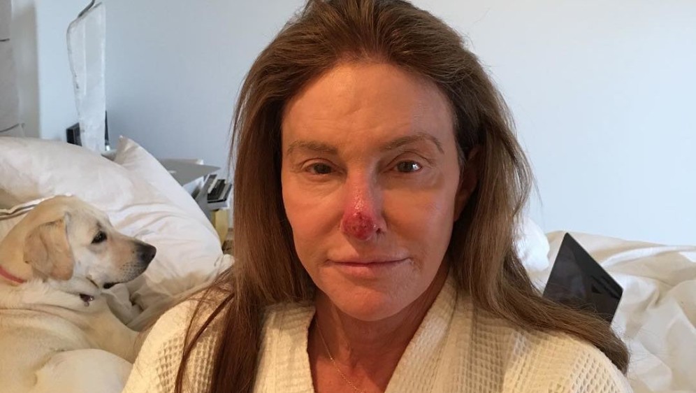 CAITLYN JENNER, rak kože