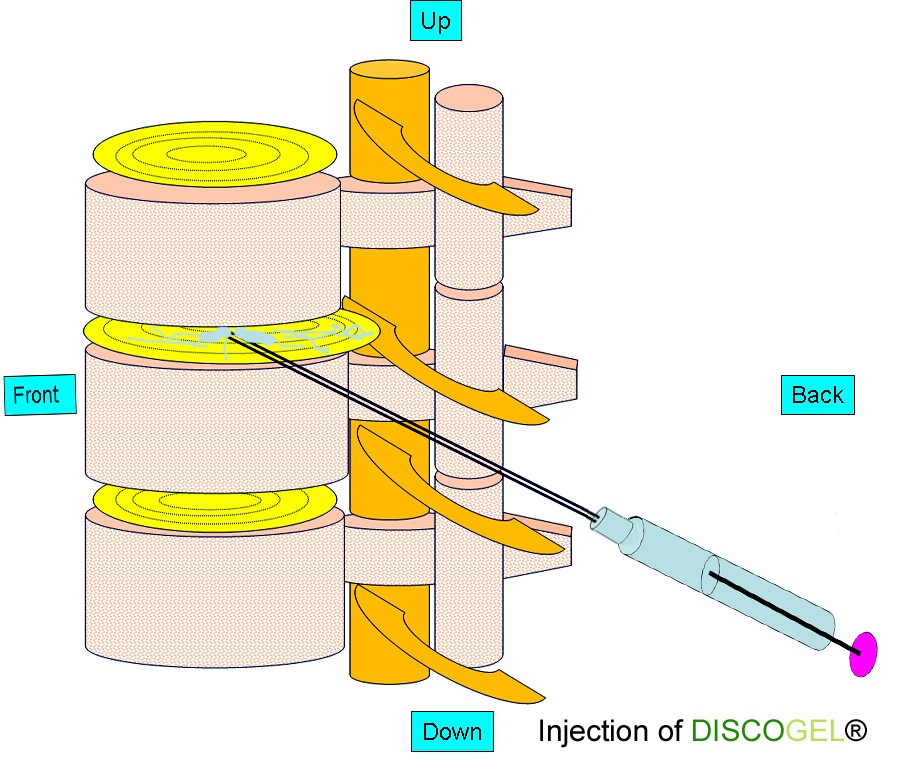 Hernija, Hernija diska, simptomi hernija diska