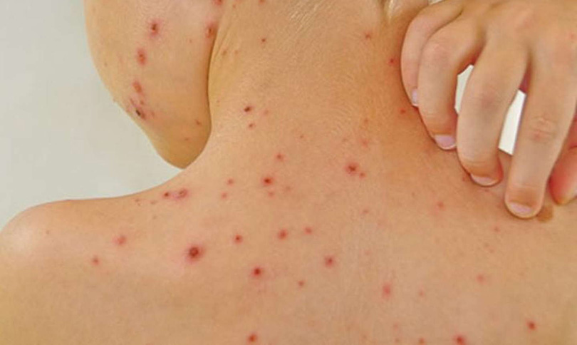 ospice, ospice, šarlah, ospice, šuga