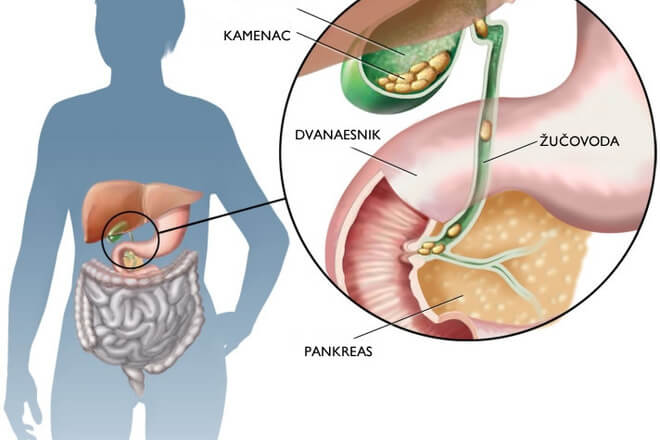 Kolecistitis, oboljenja žuči i jetre, žuč, upala žuči
