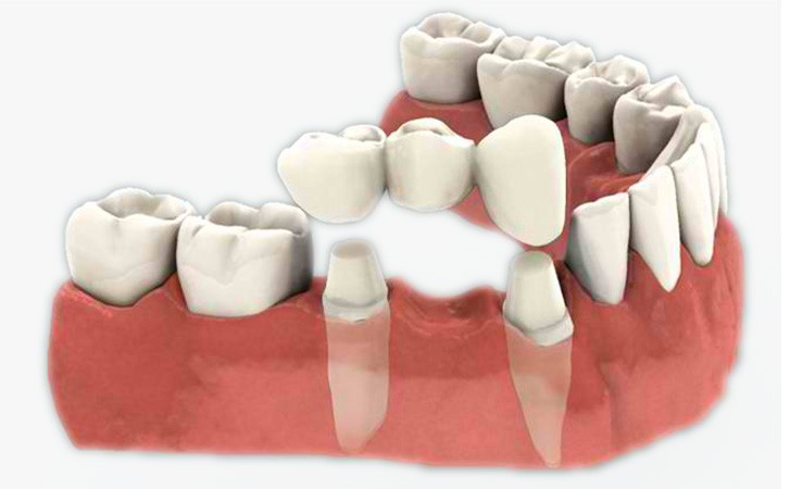 zubne krunice, zubarska ordinacija, zubar