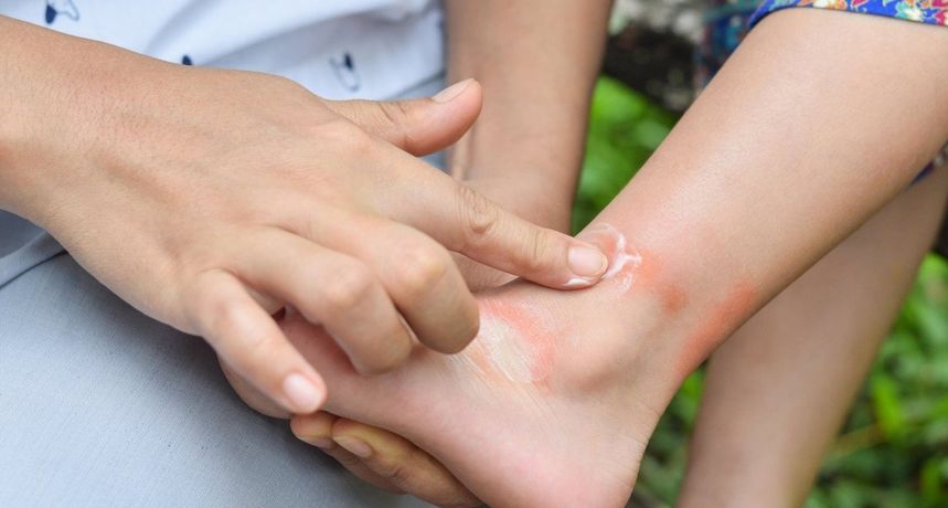  Prva pomoć: Što učiniti protiv uboda komaraca? 