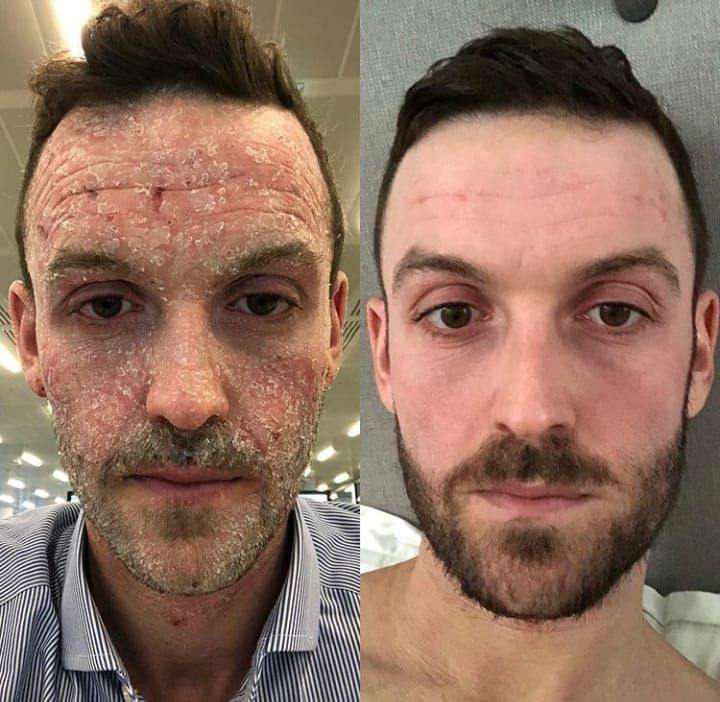 atopijski dermatitis, liječenje