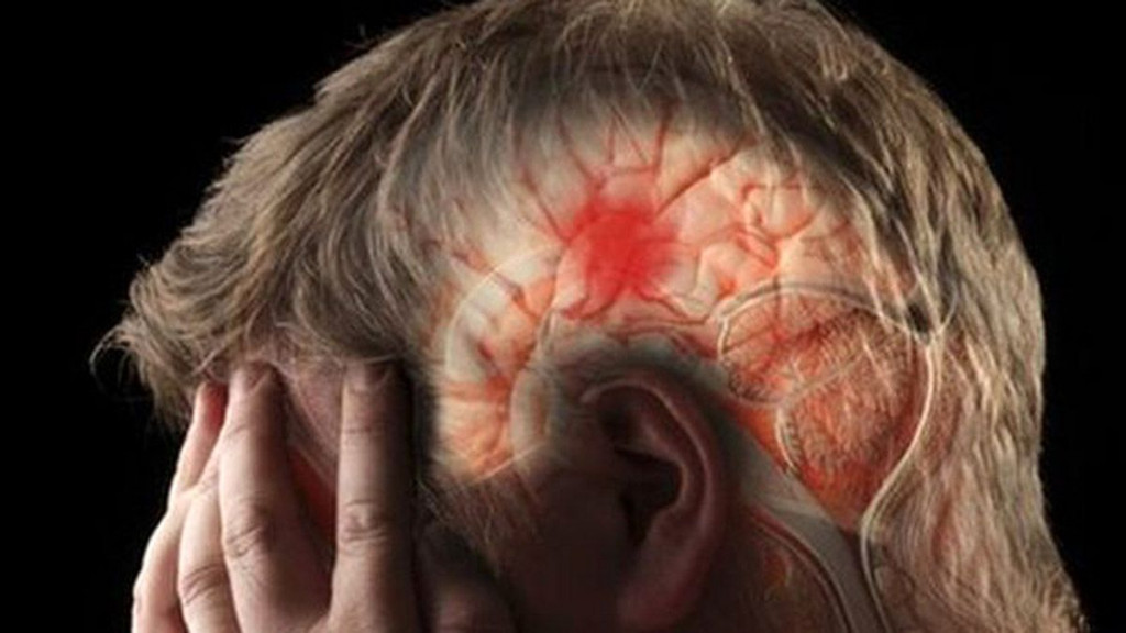 Moždani udar ilustracija